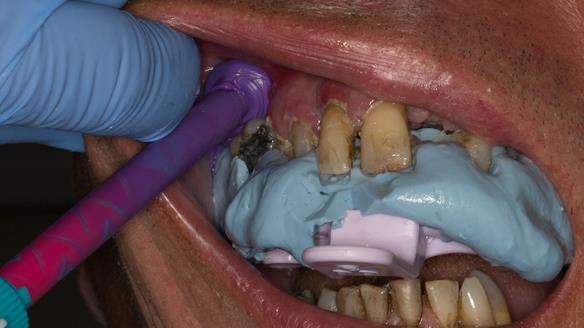 Figure 14 Stage 2 primary impression - Alginate reseated in the mouth Schottlander Doric Heavy bodied silicone used to record the depth sulcus