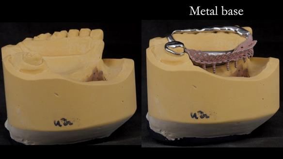 Upper metal base partial denture/occlusal stabilisation splint/obturator - full protocol