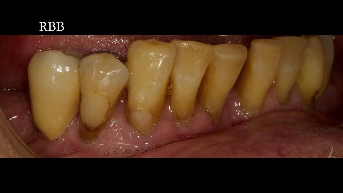 Newsletter 87 – Father Peter: A Partial Denture that needed Minor Miracle
