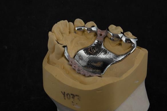 Figure 72 cobalt chromium framework - Scandinavian design - keeping the denture components 3mm away from the gingival margin.