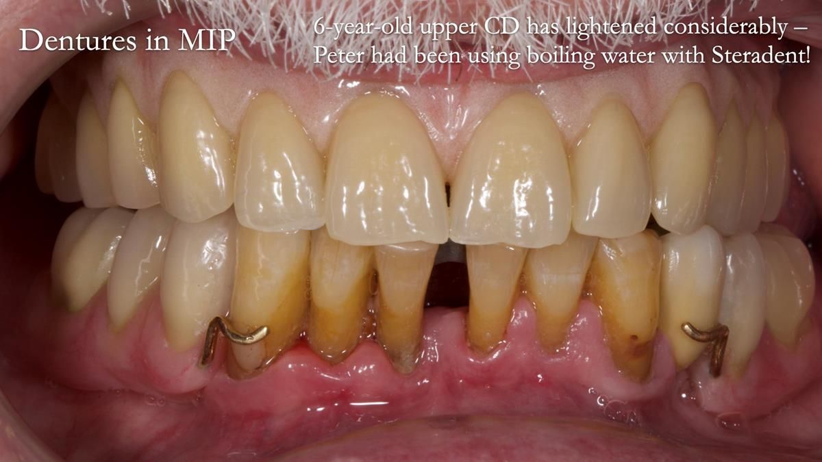 Newsletter 87 – Father Peter: A Partial Denture that needed Minor Miracle