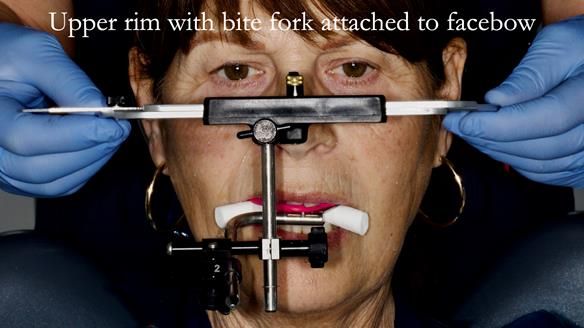 Newsletter 56 showing the making and fitting of a bilateral free end saddle upper removable partial denture (RPD) for patient with pemphigus