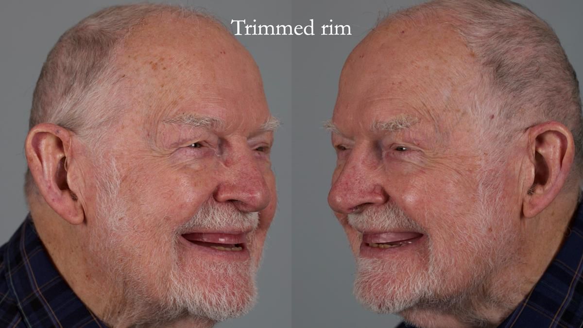 Newsletter 87 – Father Peter: A Partial Denture that needed Minor Miracle