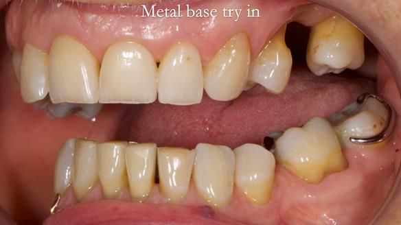 Finlay's Newsletter 61 provision of a lower unilateral free end saddle metal based partial denture for Joyce
