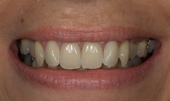 Figure 82 Fitted cobalt chromium based partial dentures with Schottlander Enigmalife teeth