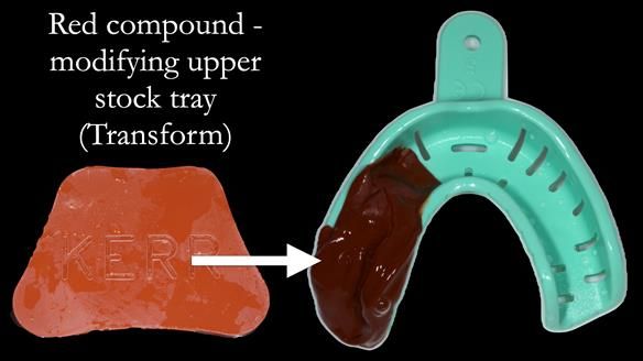 Finlay's Newsletter 61 provision of a lower unilateral free end saddle metal based partial denture for Joyce
