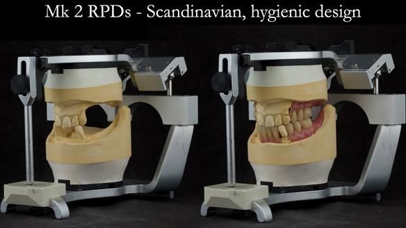 Finlay's Case Study Newsletter 40 - Immediate Mk 1 RPD to Definitive Mk 2 RPD - full protocol
