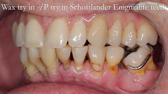 Newsletter 54 case presentation upper complete denture and lower Scandinavian designed hygienic partial denture for David