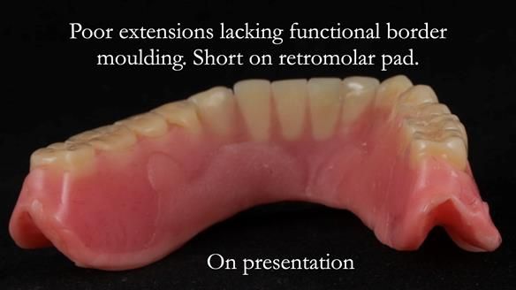 Finlay's Newsletter 62 provision of extractions and metal based complete dentures for Rafique