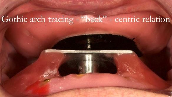 Sequence of use - patient is instructed to move lower jaw the right