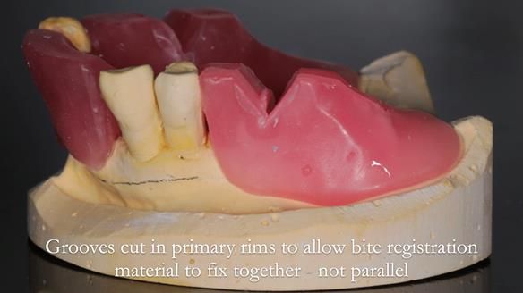Finlay's Newsletter 59 Ultra hard partial dentures made for Gill