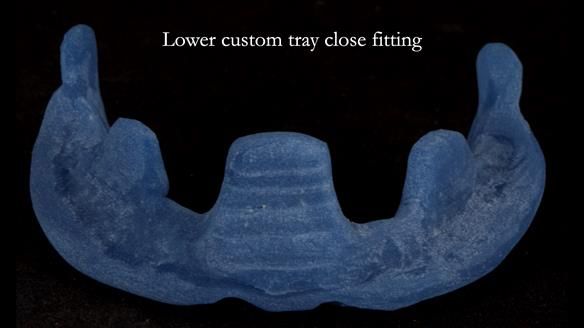 Newsletter 83: Sheila’s Complete Denture Success