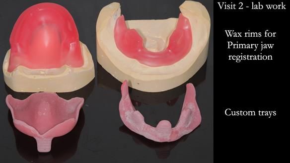 Finlay's Newsletter 62 provision of extractions and metal based complete dentures for Rafique