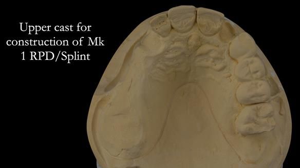 Newsletter 51 Managing Anne’s failing dentition with distal extension base RPD/Splint FULL PROTOCOL