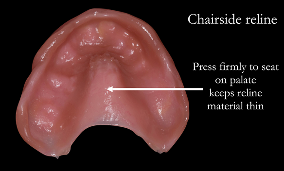 Figure 44 The denture is seated firmly onto the palate to keep the reline as thin as possible. There is no change to the vault of the palate - this is a stable support 