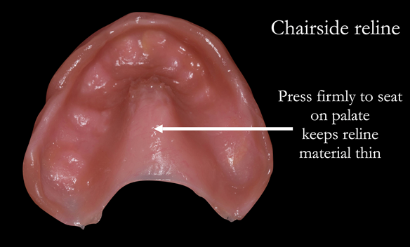 Figure 44 The denture is seated firmly onto the palate to keep the reline as thin as possible. There is no change to the vault of the palate - this is a stable support