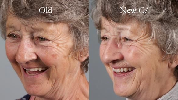 Solving Linda’s Failed “All on 4” implant bridges - full protocol Newsletter 42