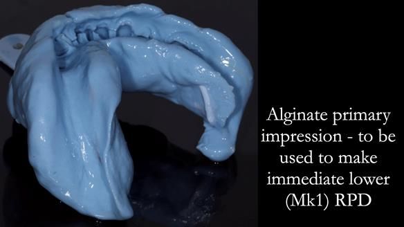 Newsletter 54 case presentation upper complete denture and lower Scandinavian designed hygienic partial denture for David