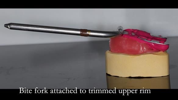 Newsletter 55 Provision of metal based partial dentures for Zephyrine with a repaired cleft lip and palate