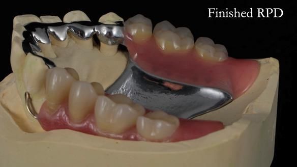 Newsletter 56 showing the making and fitting of a bilateral free end saddle upper removable partial denture (RPD) for patient with pemphigus