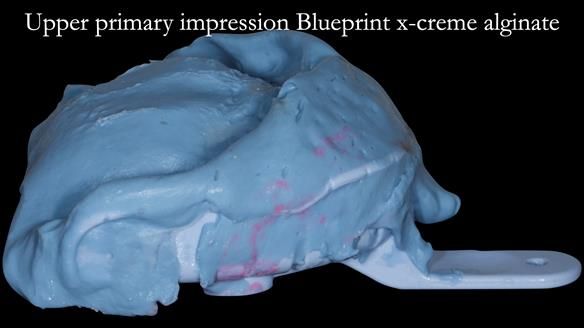 Newsletter 52 Managing Jo’s failing dentition with extractions and Mk 1/Mk 2 complete upper dentures and lower partial dentures FULL PROTOCOL