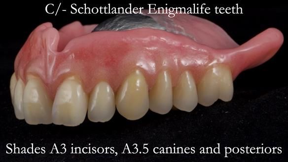 Newsletter 54 case presentation upper complete denture and lower Scandinavian designed hygienic partial denture for David