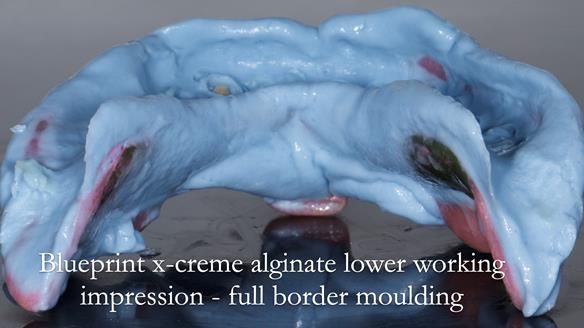 Newsletter 44 - extreme removable prosthodontics – engineering a super-strong and ultra-thin over denture