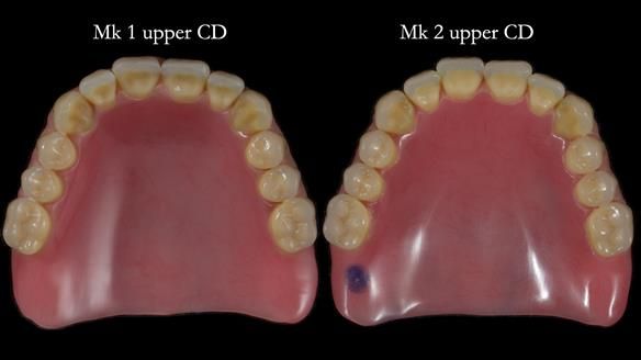 Newsletter 83: Sheila’s Complete Denture Success