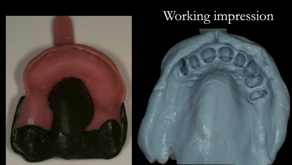 Figure 17 Upper working impression. Border moulded in greenstick followed by alginate impression with full border moulding