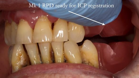 Finlay's Case Study Newsletter 40 - Immediate Mk 1 RPD to Definitive Mk 2 RPD - full protocol