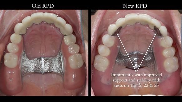 Newsletter 76: Jackie’s case – Telescopic overdenture & precision RPD (the tricky truth!)
