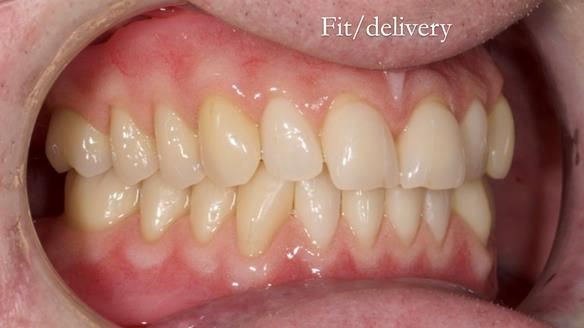 Newsletter 57 showcases the making and fitting process of implant-supported complete dentures for Alisdair