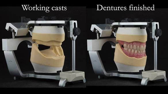 Newsletter 75: Marion’s case - Step-by-step complete denture workflow