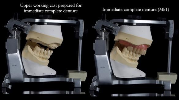 Newsletter 77: Jeremy’s case – immediate complete upper denture