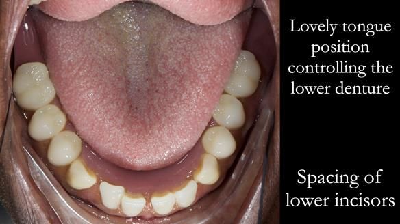 Newsletter 53 showing the making and fitting of ultra life-like dentures for Valena