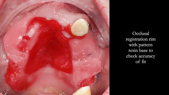 Newsletter 55 Provision of metal based partial dentures for Zephyrine with a repaired cleft lip and palate