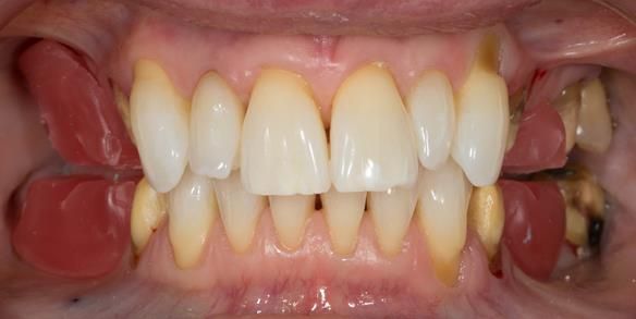 Figure 46 Upper and lower wax registration rims trimmed with space between them and the anterior teeth contact in ICP.