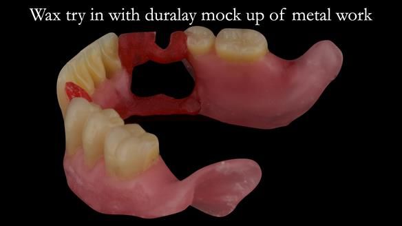 Finlay's Case Study Newsletter 40 - Immediate Mk 1 RPD to Definitive Mk 2 RPD - full protocol