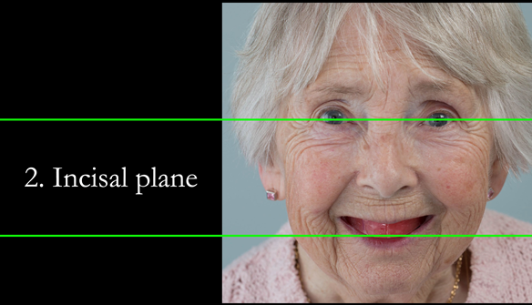 Figure 69 The incsial plane is generally carved parallel to the inter-pupillary plane