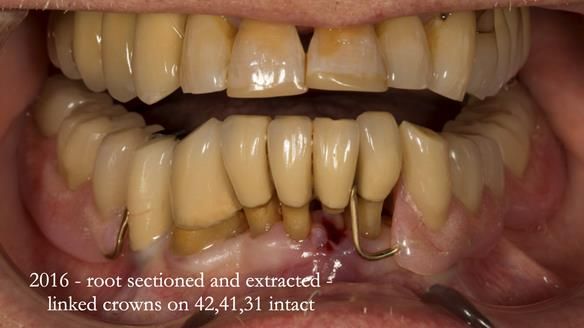 Ken – going downhill, first class
