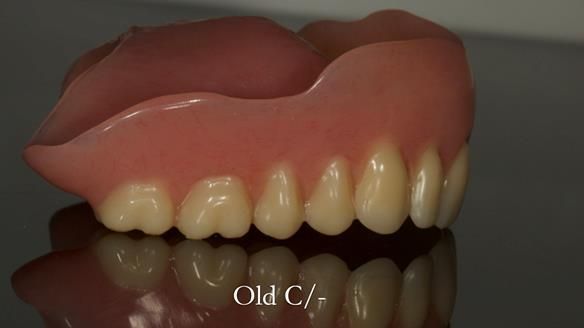 Complete denture Class II div 2 deep overbite Newsletter 39