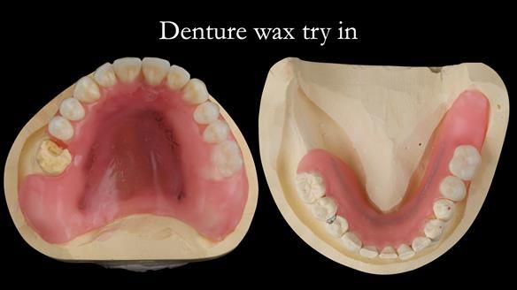 Newsletter 52 Managing Jo’s failing dentition with extractions and Mk 1/Mk 2 complete upper dentures and lower partial dentures FULL PROTOCOL