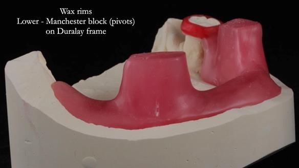 Finlay's Newsletter 59 Ultra hard partial dentures made for Gill