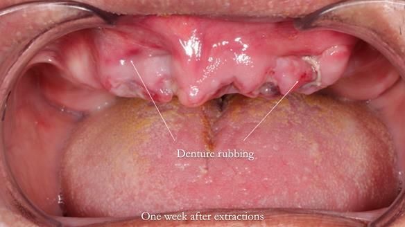 Finlay's Newsletter 62 provision of extractions and metal based complete dentures for Rafique