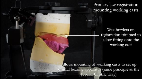 Newsletter 53 showing the making and fitting of ultra life-like dentures for Valena