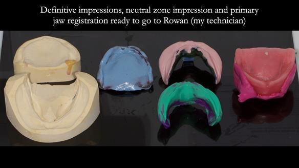 Newsletter 83: Sheila’s Complete Denture Success