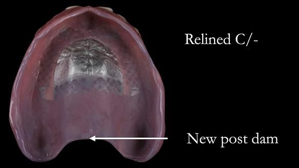 Newsletter 53 showing the making and fitting of ultra life-like dentures for Valena