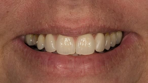 Finlay's Newsletter 63 Case study provision of metal based Scandinavian RPD - functional 10 years on