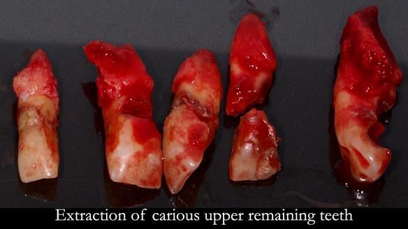 Finlay's Newsletter 62 provision of extractions and metal based complete dentures for Rafique
