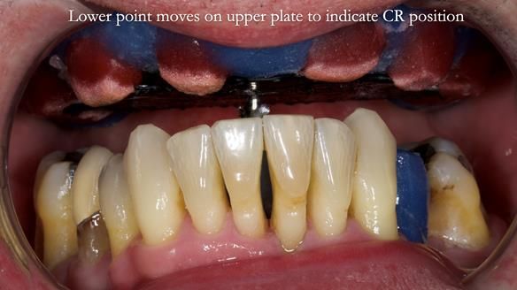 Newsletter 77: Jeremy’s case – immediate complete upper denture